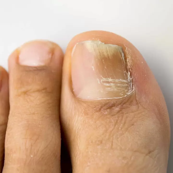 Toenail fungus